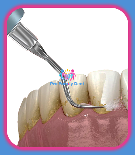 Detartraj Igienizare AirFlow Targu Neamt Oferta Pret Pareri - Servicii Clinica Pro Family Dent