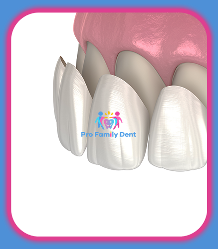 Fatete Zirconiu Ceramica E-Max Targu Neamt Oferta Pret Pareri - Servicii Clinica Pro Family Dent