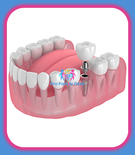 Implanturi Dentare Targu Neamt Oferta Pret Pareri - Servicii Clinica Pro Family Dent