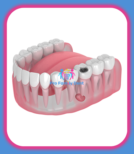 Tratament Carii Dentare Targu Neamt Oferta Pret Pareri - Servicii Clinica Pro Family Dent