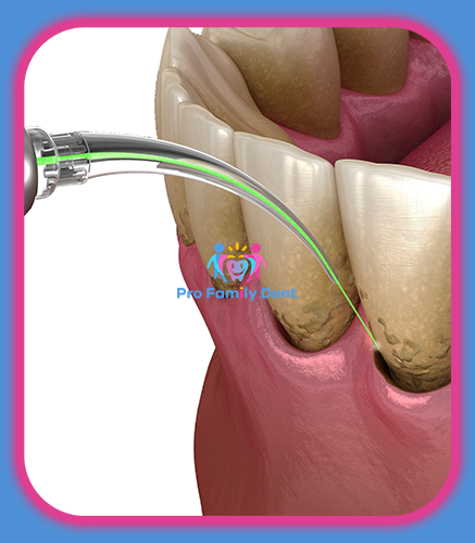 Tratament Parodontoza LASER Targu Neamt Oferta Pret Pareri - Servicii Clinica Pro Family Dent