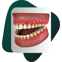 Detartraj Dentar DOAR 95 LEI Stomatologie Iasi Giovinesse Dental - Tartru pe Dinti 3D