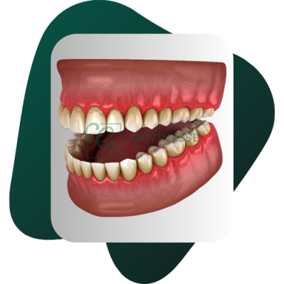 Detartraj Dentar DOAR 95 LEI Stomatologie Iasi Giovinesse Dental - Tartru pe Dinti 3D