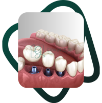 Detartraj Dentar DOAR 95 LEI Stomatologie Iasi Giovinesse Dental - Implant Dentar 3D