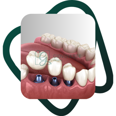 Detartraj Dentar DOAR 95 LEI Stomatologie Iasi Giovinesse Dental - Implant Dentar 3D