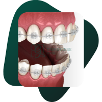 Detartraj Dentar DOAR 95 LEI Stomatologie Iasi Giovinesse Dental - Aparat Dentar 3D