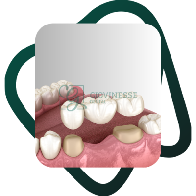 Detartraj Dentar DOAR 95 LEI Stomatologie Iasi Giovinesse Dental - Dinti Ficsi All-on-4 3D