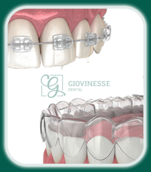 Aparate Dentare Safir Invizibile Invisalign Iași Oferta Pret Pareri - Servicii Clinica Giovinesse Dental