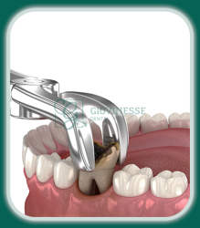 Chirurgie Dentară Iași Oferta Pret Pareri - Servicii Clinica Giovinesse Dental