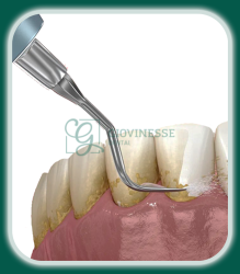 Detartraj Igienizare AirFlow Iași Oferta Pret Pareri - Servicii Clinica Giovinesse Dental