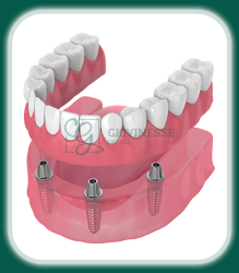 Dinti Ficsi All-on-4 Fast&Fixed Iași Oferta Pret Pareri - Servicii Clinica Giovinesse Dental