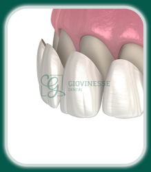 Fatete Zirconiu Ceramica E-Max Iași Oferta Pret Pareri - Servicii Clinica Giovinesse Dental
