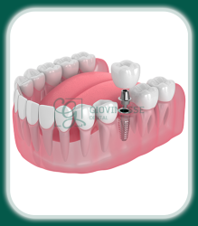 Implanturi Dentare Iași Oferta Pret Pareri - Servicii Clinica Giovinesse Dental