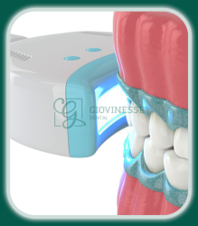 Tratament Albire Dentara LASER Iași Oferta Pret Pareri - Servicii Clinica Giovinesse Dental