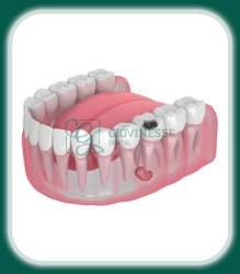 Tratament Carii Dentare Iași Oferta Pret Pareri - Servicii Clinica Giovinesse Dental