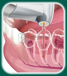 Tratament Endodontic de Canal LASER Iași Oferta Pret Pareri - Servicii Clinica Giovinesse Dental