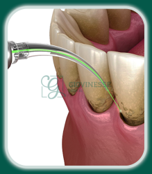 Tratament Parodontoza LASER Iași Oferta Pret Pareri - Servicii Clinica Giovinesse Dental